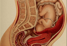 Does Anterior Placenta Change Normal Delivery In India?